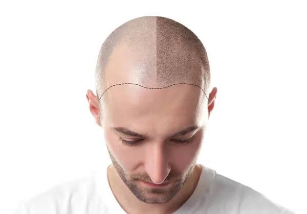 Hair transplant procedures at Sindhu Skin & Hair Clinic in Washim